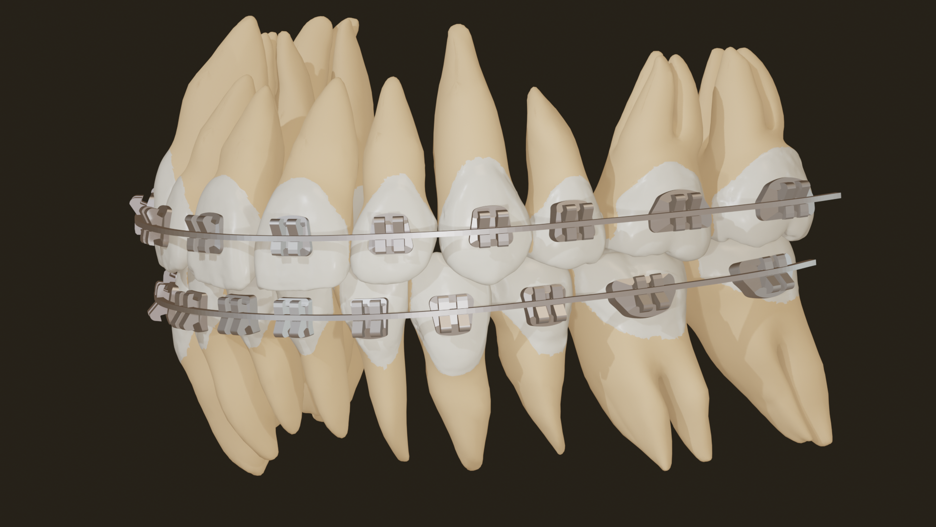 Via Brackets
