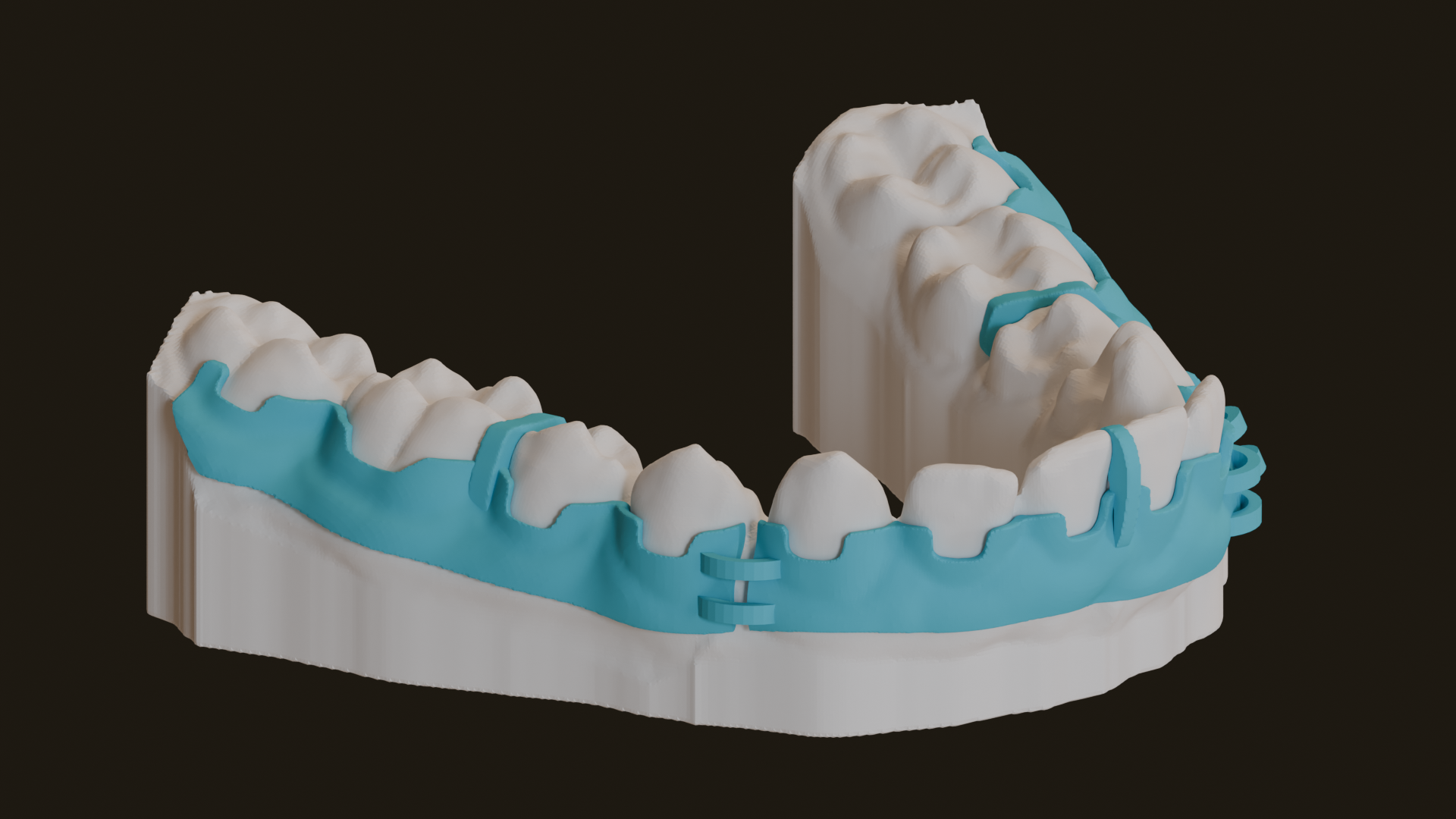 Via Guide with brackets